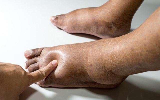 Почему у пожилого человека отекают ноги и как уменьшить отёчность