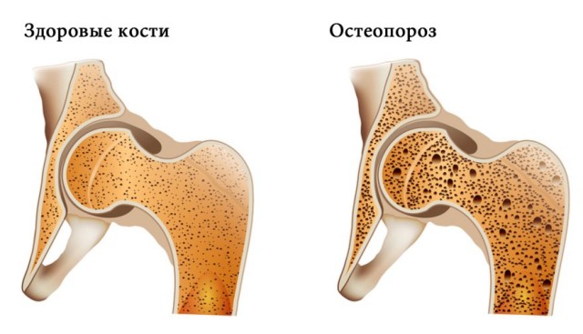 Что нужно знать про остеопороз